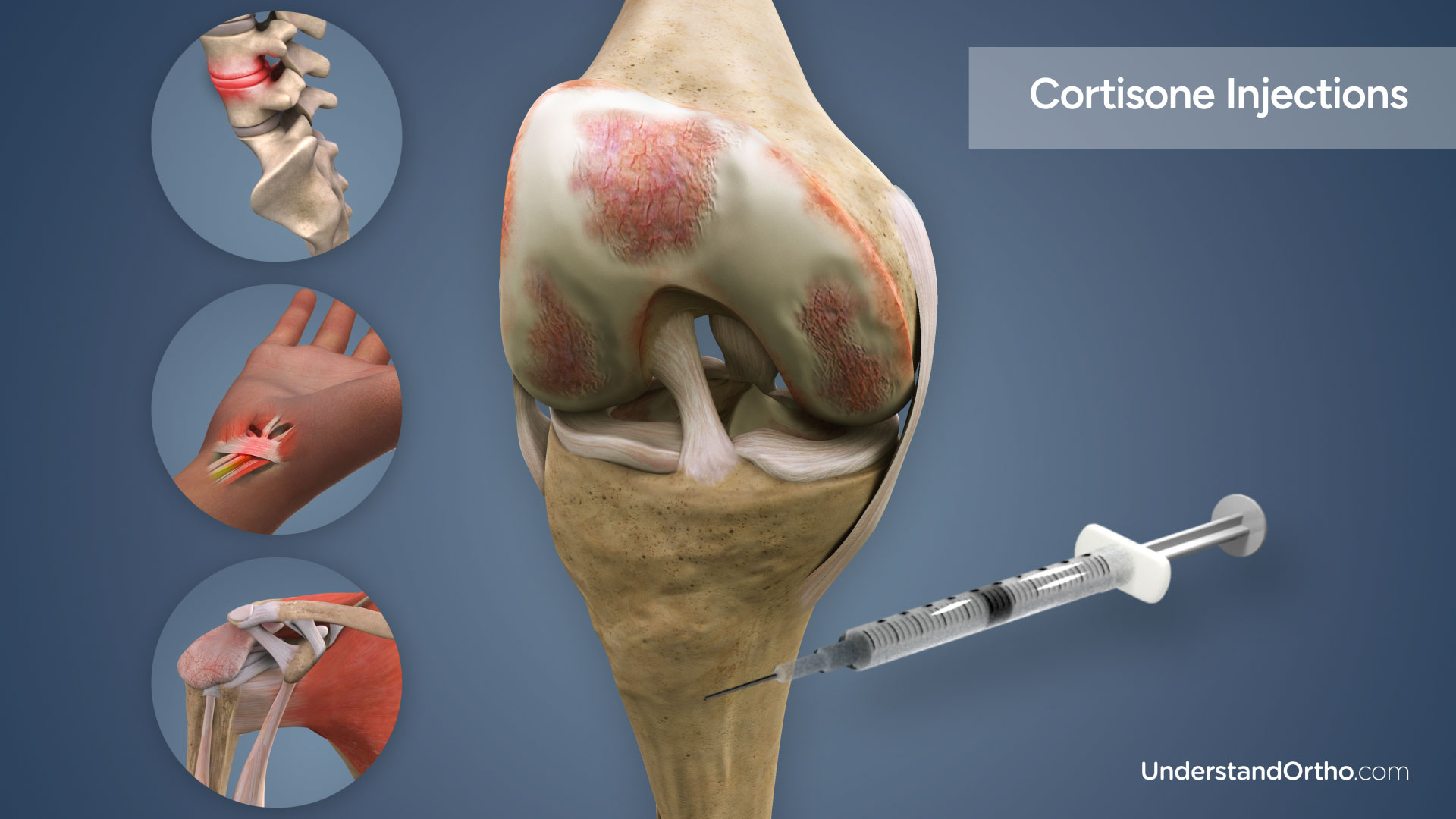 3D rendering of the knee with a syringe next to it filled with corticosteroids