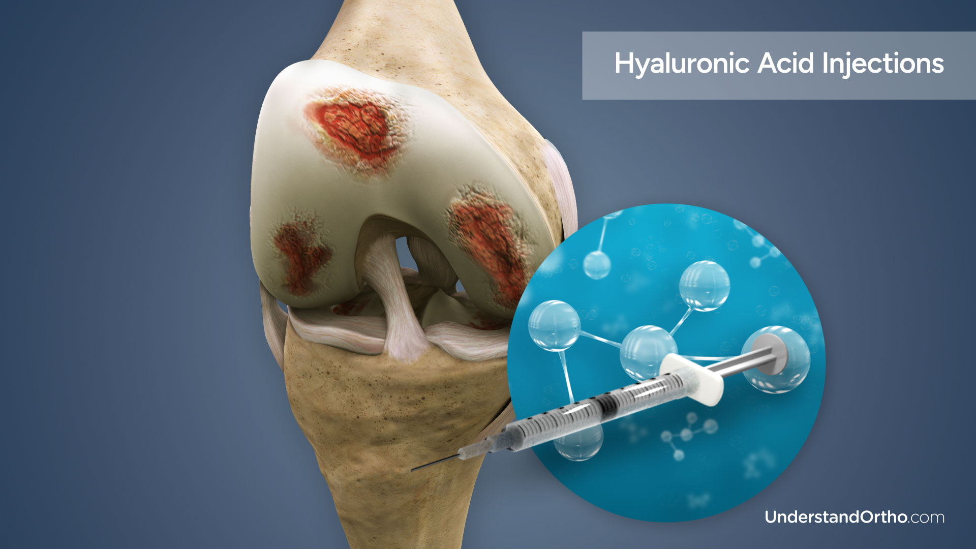 3D rendering of the knee next to a syringe filled with hyaluronic acid