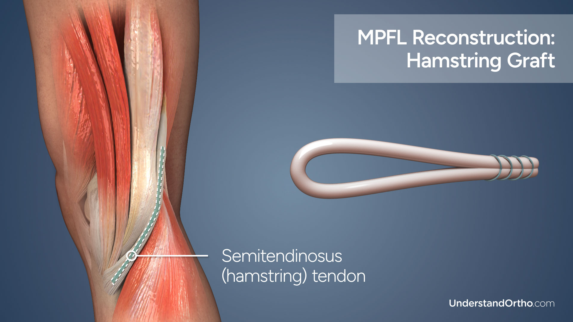 3D rendering of the backside of the knee showing muscles and tendons, and displaying an MPFL hamstring graft in the foreground