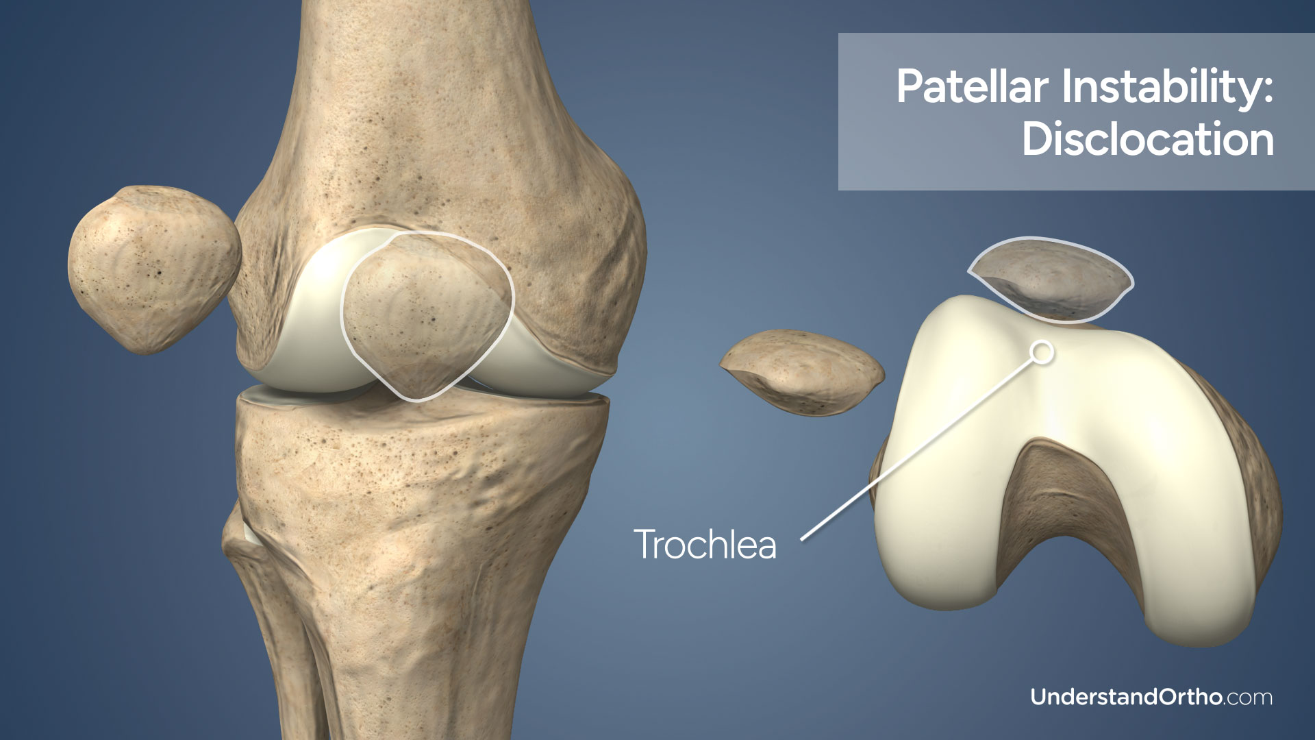 Two viewpoints of the knee showing patellar dislocation (3d rendering)