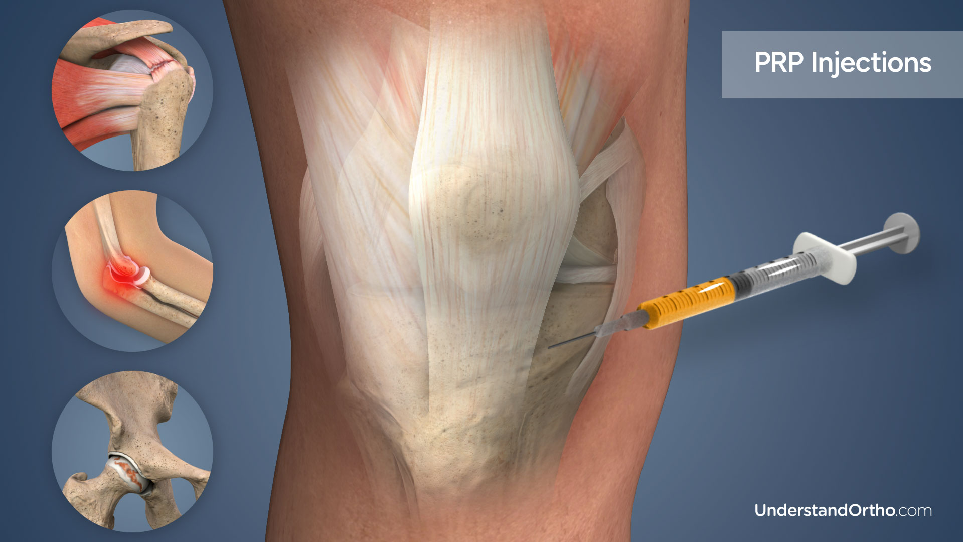 3D rendering of the knee with a syringe next to it filled with platelet-rich plasma