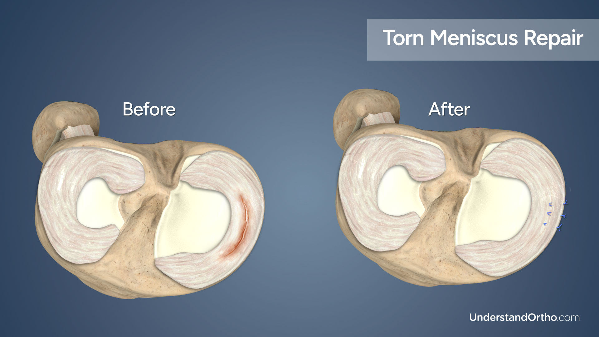 Two 3D renderings of the inner knee juxtaposed with the left image depicting a knee with a longitudinal meniscus tear and the right image showing a repaired meniscus