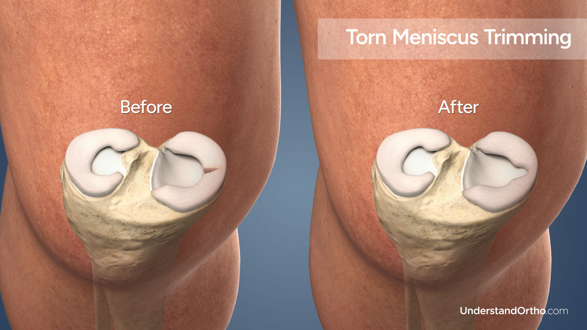 Two 3D renderings of the knee juxtaposed both displaying the tibia and menisci, left image shows a radial tear, the right image shows a meniscus that has been repaired with trimming