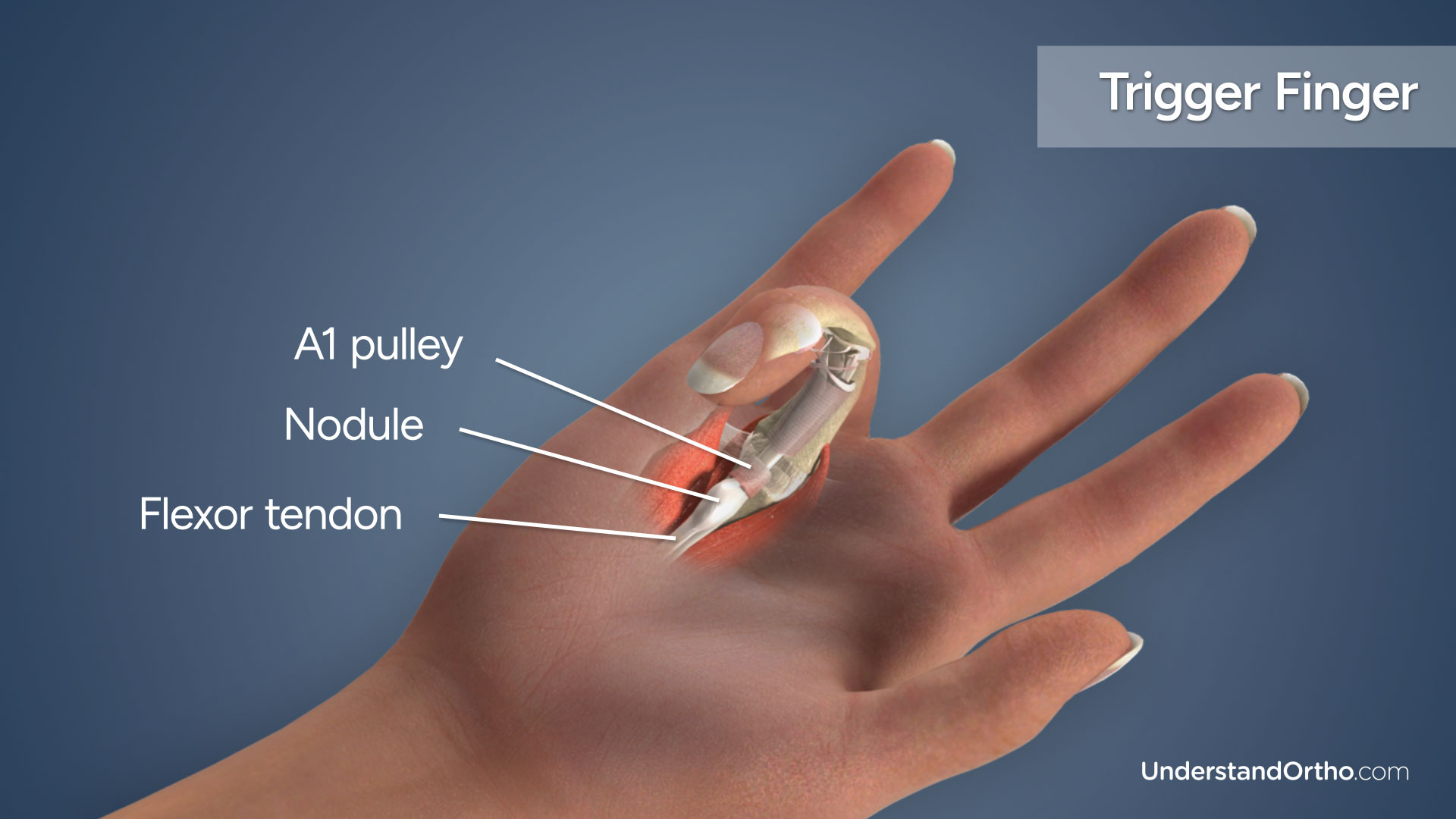 Trigger Finger Release