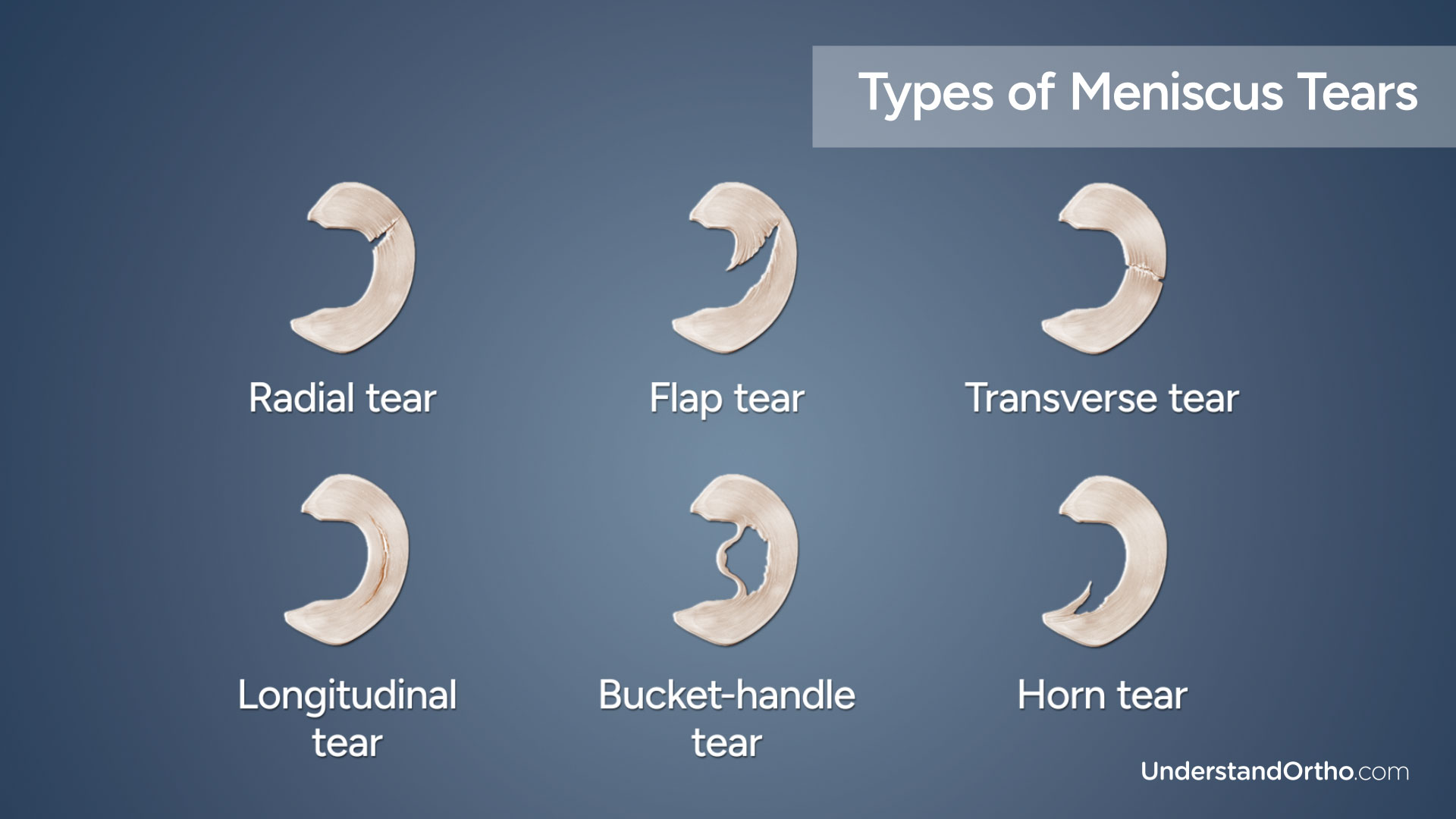 The 6 meniscal tears: Radial, Flap, Transverse, Longitudinal, Bucket-handle, Horn