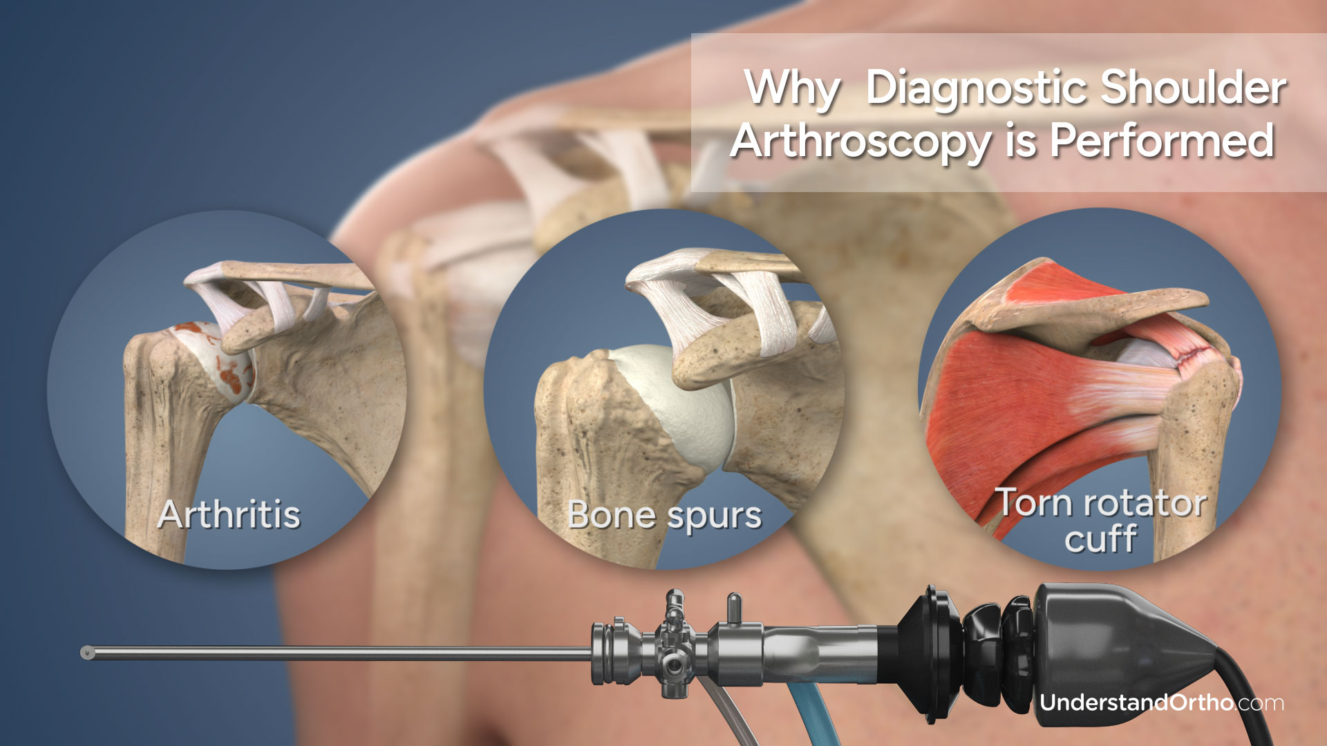 3D renderings of the shoulder showing the three major reasons why shoulder arthroscopy is performed: arthritis, bone spurs, torn rotator cuff